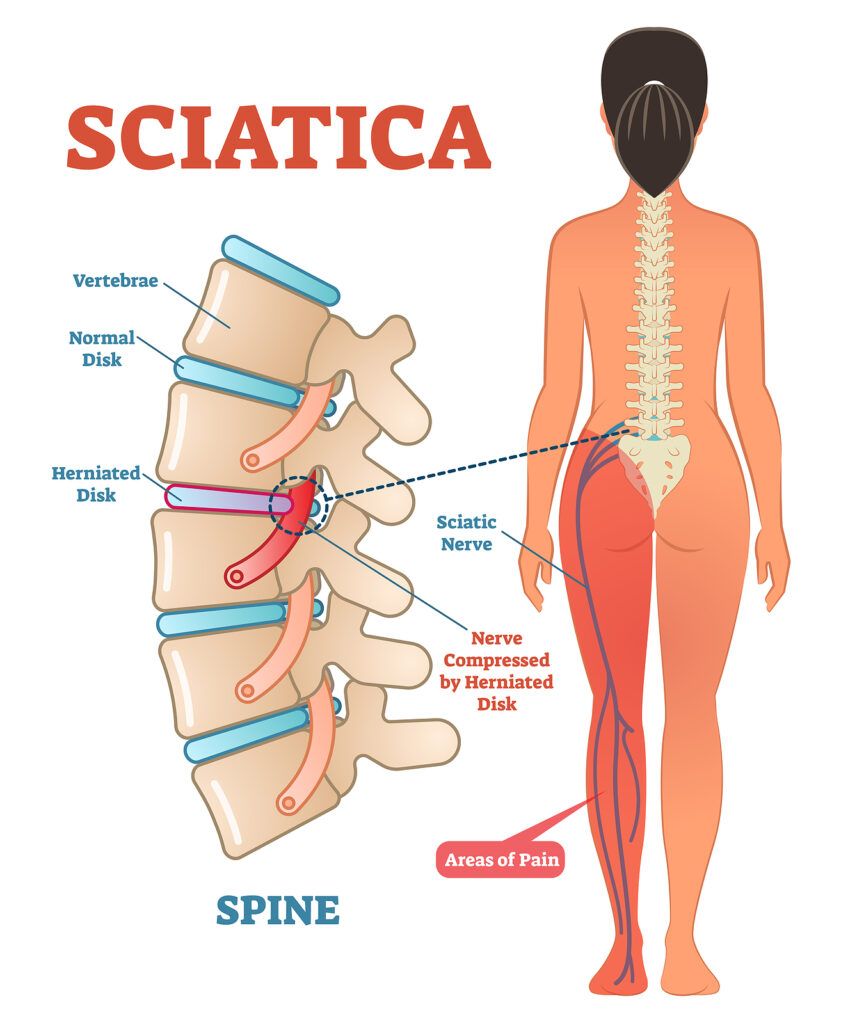 sciatica from herniated disc